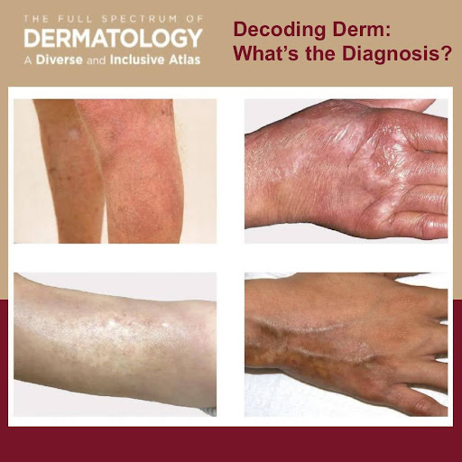 Journal of Drugs in Dermatology JDD About The Full Spectrum of Dermatology: A Diverse and Inclusive Atlas. The images is of morphea among different skin tones