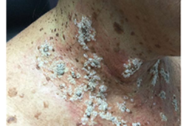 Journal of Drugs in Dermatology JDD Article about Management of Hailey-Hailey Disease With Ruxolitinib 1.5% Cream