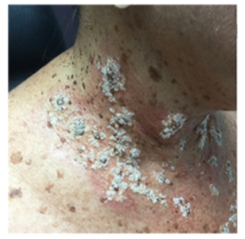 Journal of Drugs in Dermatology JDD Article about Management of Hailey-Hailey Disease With Ruxolitinib 1.5% Cream