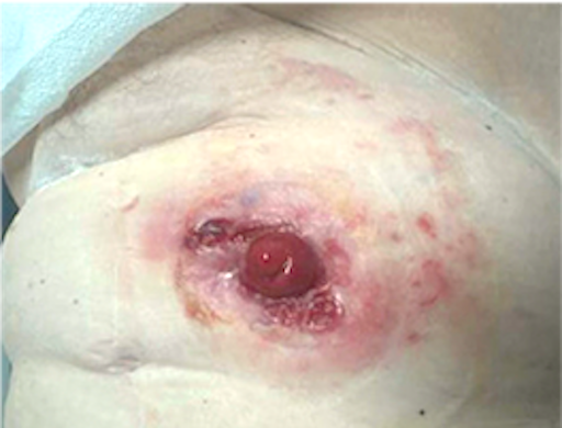 Journal of Drugs in Dermatology JDD Article about Pyoderma Gangrenosum Following Total Colectomy for Ulcerative Colitis