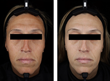 Journal of Drugs in Dermatology JDD Article about Clinical Evaluation of Thiamidol-Containing Formulations for the Visual Management of Facial Hyperpigmentation