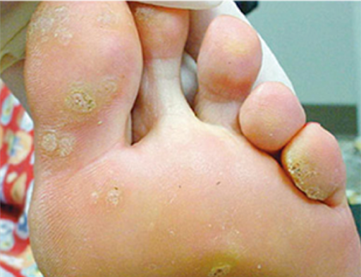 Journal of Drugs in Dermatology JDD Article about The Current Landscape of Treatment of Warts