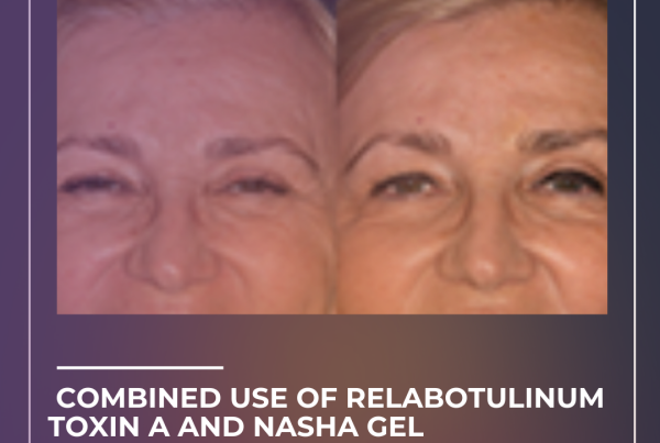Journal of Drugs in Dermatology JDD Article about Combined Use of Relabotulinum Toxin A and NASHA Gel Skinbooster for Rejuvenation of the Upper Third of the Face