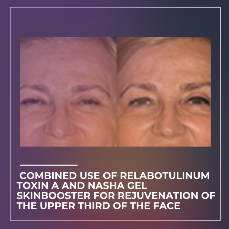 Journal of Drugs in Dermatology JDD Article about Combined Use of Relabotulinum Toxin A and NASHA Gel Skinbooster for Rejuvenation of the Upper Third of the Face