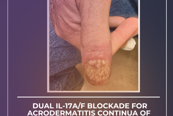 Journal of Drugs in Dermatology JDD Article about Dual IL-17A/F Blockade for Acrodermatitis Continua of Hallopeau: A Clinical Response to Bimekizumab. Image shows thumb and nail or patient.