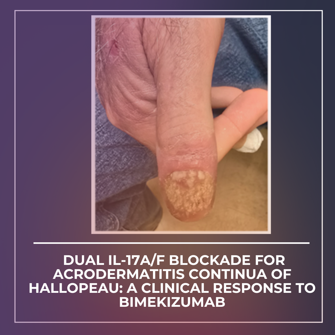 Journal of Drugs in Dermatology JDD Article about Dual IL-17A/F Blockade for Acrodermatitis Continua of Hallopeau: A Clinical Response to Bimekizumab. Image shows thumb and nail or patient.