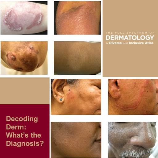 Journal of Drugs in Dermatology JDD About The Full Spectrum of Dermatology: A Diverse and Inclusive Atlas. The images is of sarcoidosis among different skin tones