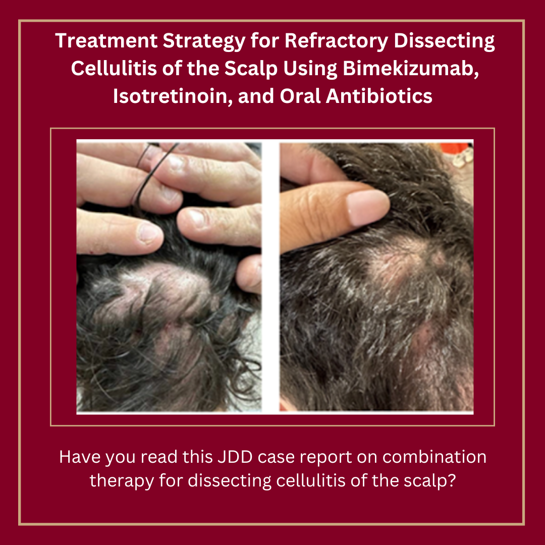 Journal of Drugs in Dermatology JDD Article about Treatment Strategy for Refractory Dissecting Cellulitis of the Scalp Using Bimekizumab, Isotretinoin, and Oral Antibiotics