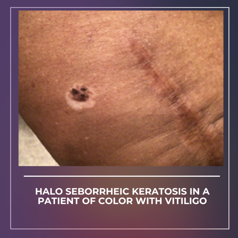 Journal of Drugs in Dermatology JDD Article about Halo Seborrheic Keratosis in a Patient of Color With Vitiligo