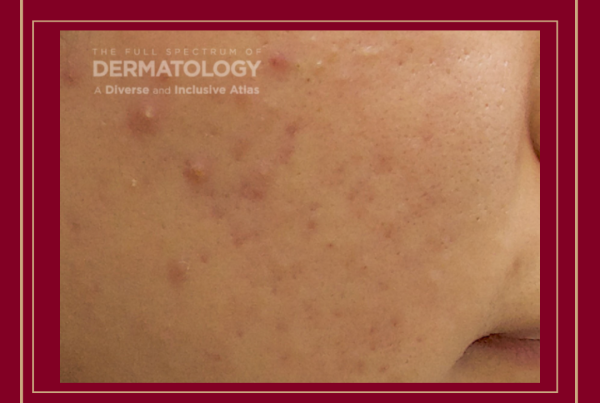 Journal of Drugs in Dermatology JDD Article about Practical Algorithm for Acne Treatment Integrating Skincare and Energy Based Devices