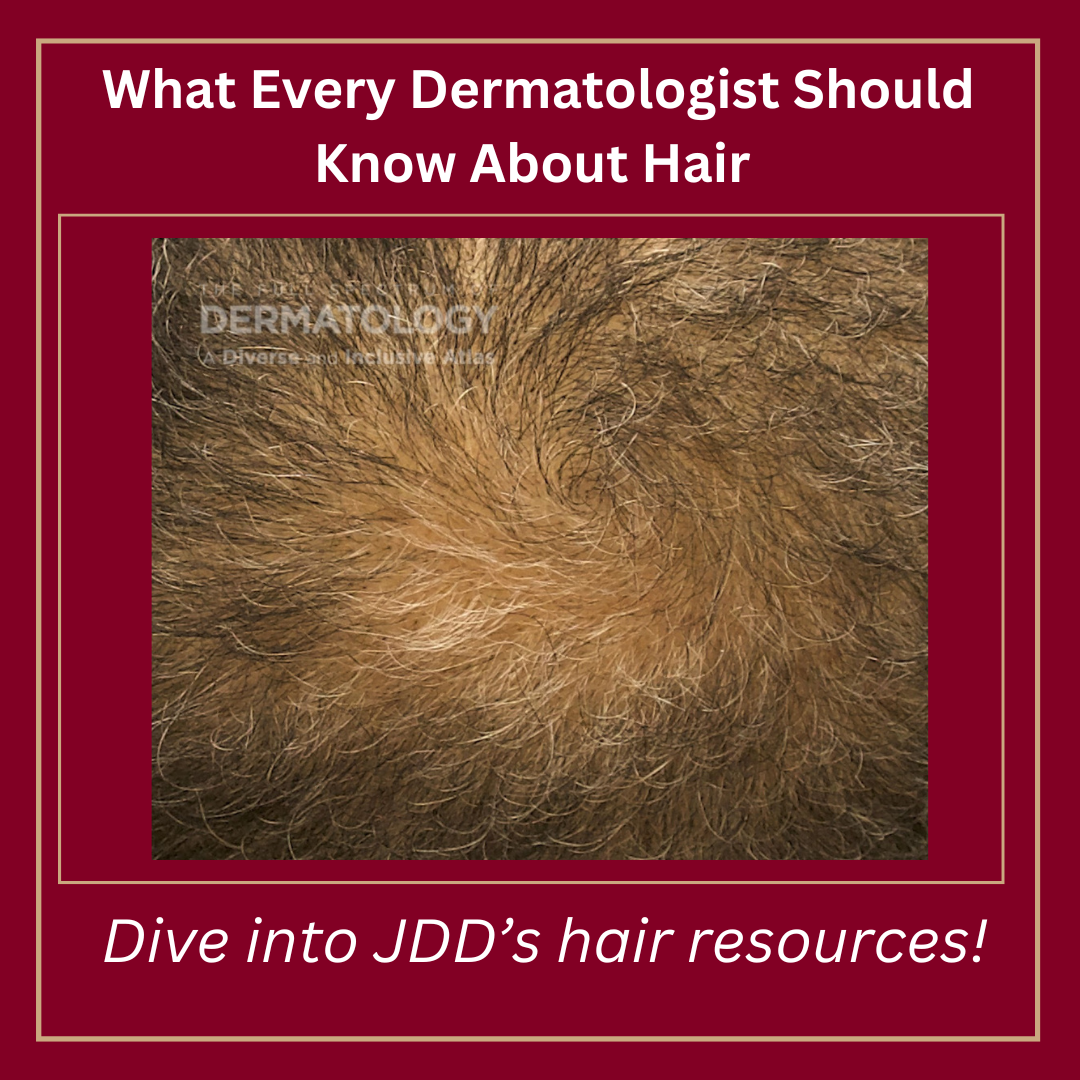 Journal of Drugs in Dermatology JDD Article about Exploring the Potential Link Between Minoxidil Use and Rosacea Using A Real-World Data Base