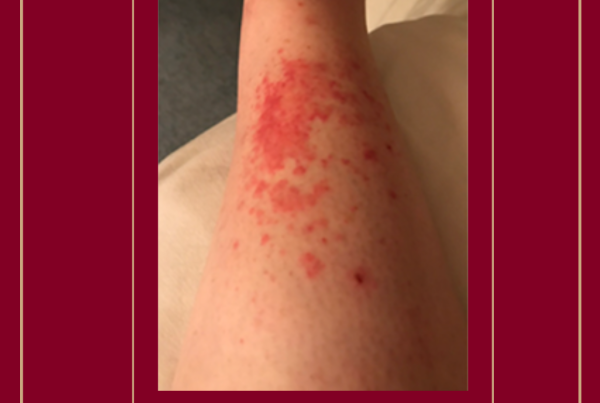 Journal of Drugs in Dermatology JDD Article about Rapid Clearance of Lichen Planus With Topical Tapinarof