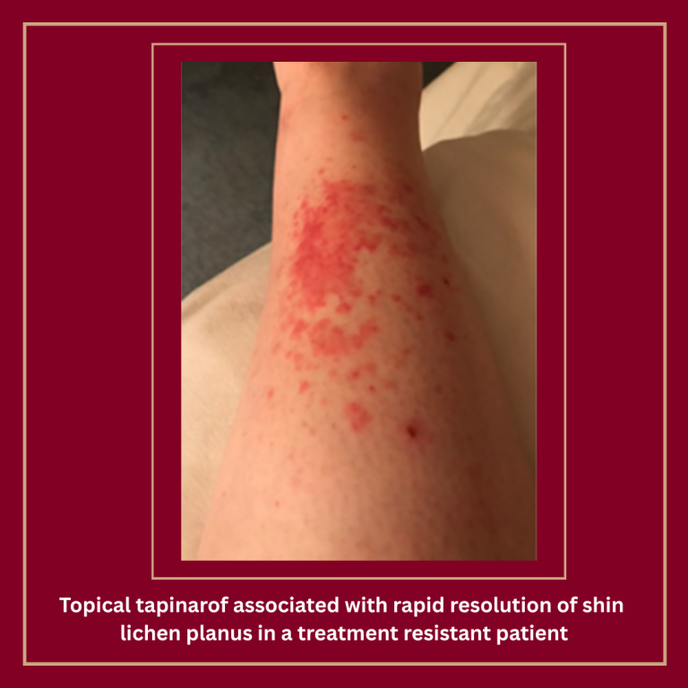 Journal of Drugs in Dermatology JDD Article about Rapid Clearance of Lichen Planus With Topical Tapinarof