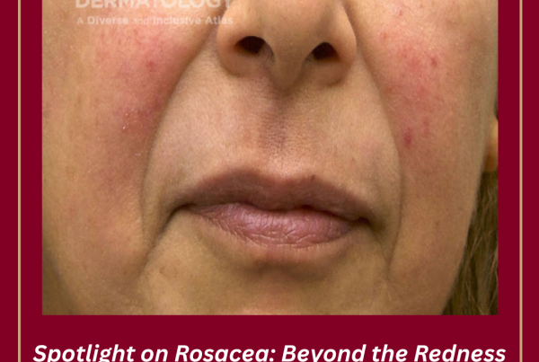 Journal of Drugs in Dermatology JDD About Rosacea Awareness Month. A Woman Patient with medium skin tone with rosacea on her cheeks.