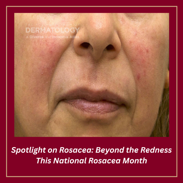 Journal of Drugs in Dermatology JDD About Rosacea Awareness Month. A Woman Patient with medium skin tone with rosacea on her cheeks.