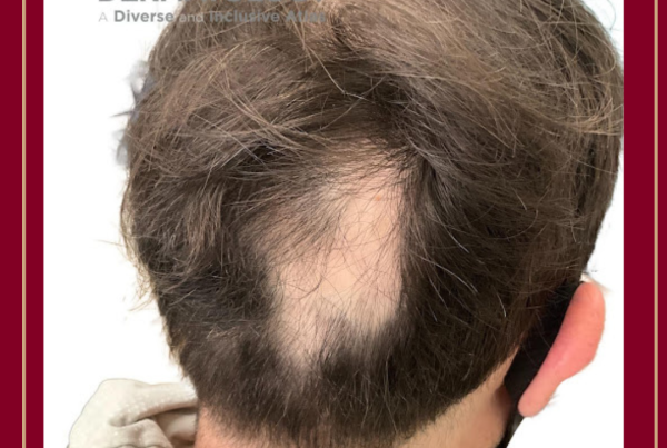 Journal of Drugs in Dermatology JDD featuring Alopecia Areata: The Clinician and Patient Voice