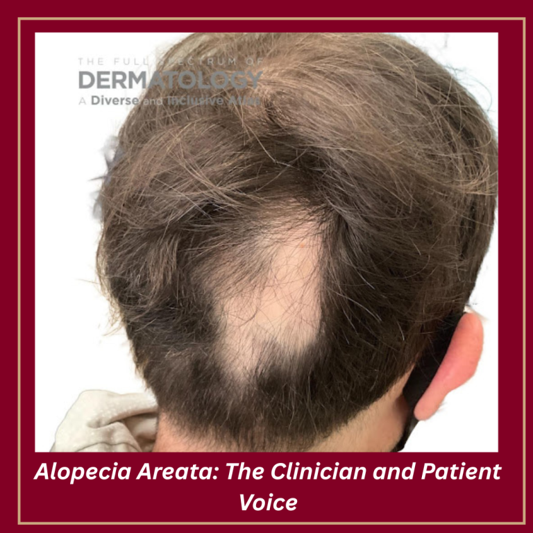 Journal of Drugs in Dermatology JDD featuring Alopecia Areata: The Clinician and Patient Voice