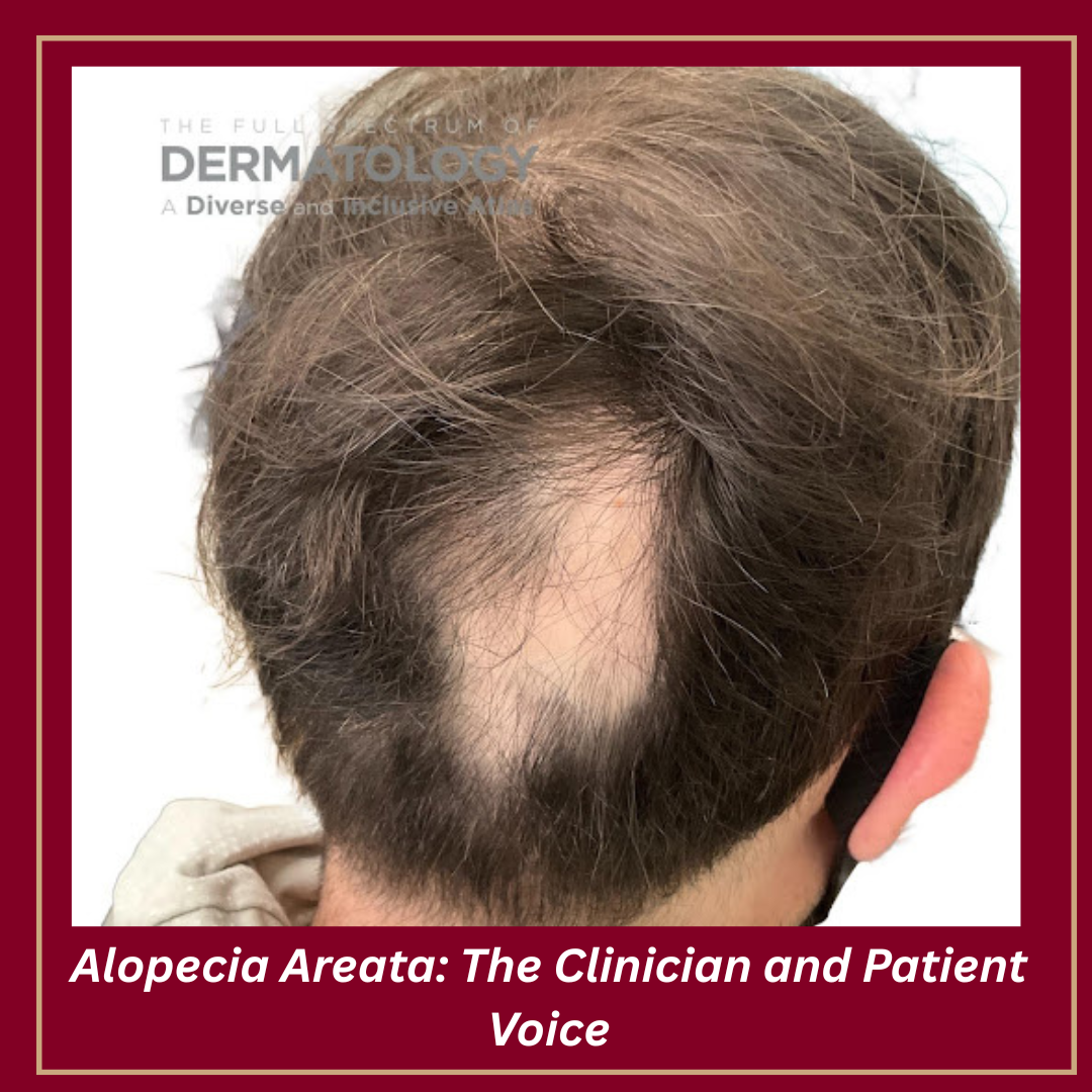 Journal of Drugs in Dermatology JDD featuring Alopecia Areata: The Clinician and Patient Voice