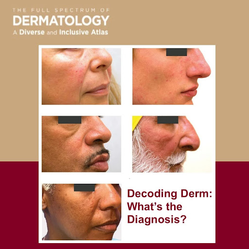 Journal of Drugs in Dermatology JDD About The Full Spectrum of Dermatology: A Diverse and Inclusive Atlas. The images is of rosacea among different skin tones