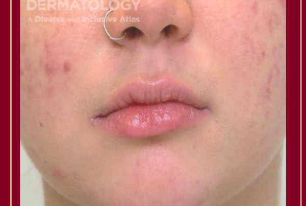 Journal of Drugs in Dermatology JDD Article About Acne Awareness Month. The image is from the Full Spectrum of Dermatology: A Diverse and Inclusive Atlas. It shows a pediatric patient with light skin tone and acne, along with hyperpigmentation.