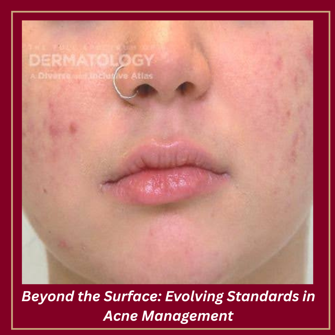 Journal of Drugs in Dermatology JDD Article About Acne Awareness Month. The image is from the Full Spectrum of Dermatology: A Diverse and Inclusive Atlas. It shows a pediatric patient with light skin tone and acne, along with hyperpigmentation.