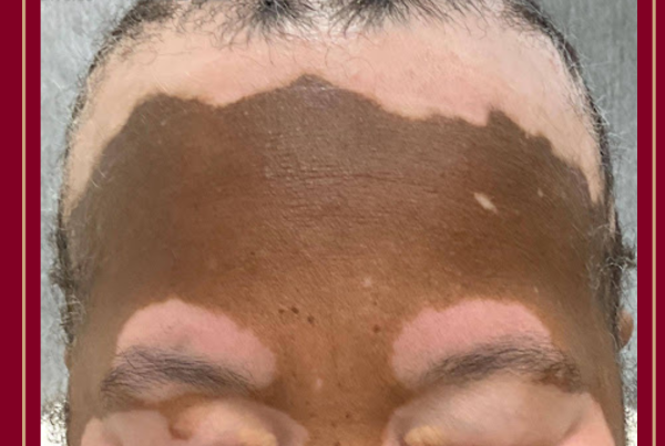 Journal of Drugs in Dermatology JDD Article About world vitiligo day. The image is from The Full Spectrum of Dermatology: A Diverse and Inclusive Atlas of a patient with skin of color who has vitiligo on the scalp, face, and forehead. The patient has darker skin tone.