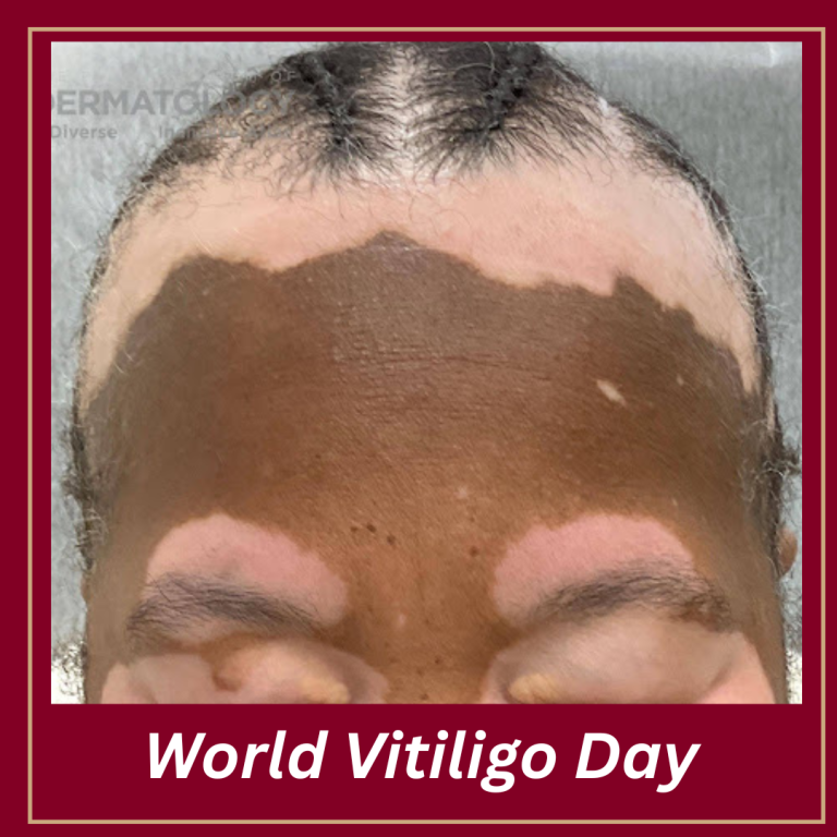 Journal of Drugs in Dermatology JDD Article About world vitiligo day. The image is from The Full Spectrum of Dermatology: A Diverse and Inclusive Atlas of a patient with skin of color who has vitiligo on the scalp, face, and forehead. The patient has darker skin tone.
