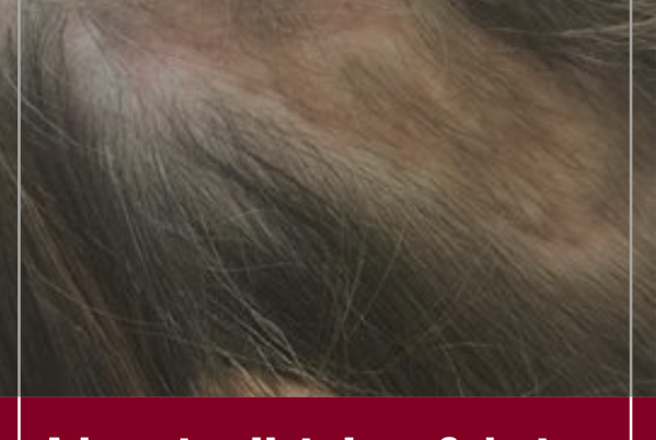 Journal of Drugs in Dermatology JDD featuring GLP-1 Receptor Agonist Use for Diabetes Mellitus is Associated With Reduced Psoriasis Disease Severity