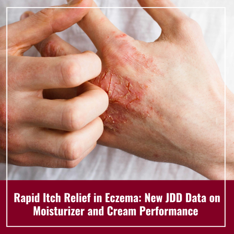 Journal of Drugs in Dermatology JDD featuring Clinical Characteristics and Time to Onset of JAK-Inhibitor-Associated Acne: A Retrospective Chart Review Study