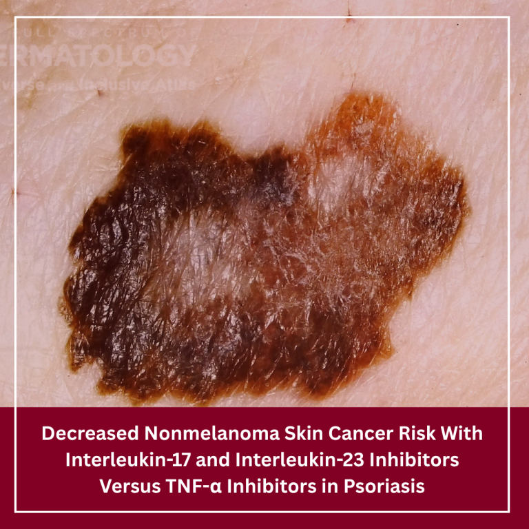 Journal of Drugs in Dermatology JDD featuring Decreased Nonmelanoma Skin Cancer Risk With Interleukin-17 and Interleukin-23 Inhibitors Versus TNF-α Inhibitors in Psoriasis