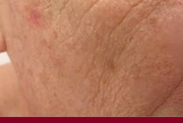 Journal of Drugs in Dermatology JDD featuring Injectable NASHA Gel Skinbooster for Facial Skin Aging in Premenopausal and Postmenopausal Women With Estrogen Deficiency-Associated Not Receiving Hormone Therapy: A Case Series