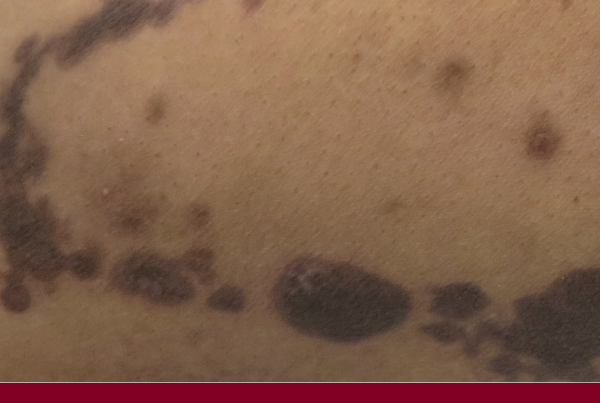 Journal of Drugs in Dermatology JDD featuring Beyond the Dark Spot: Modern Strategies for Stubborn Hyperpigmentation