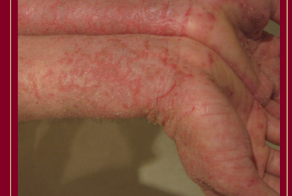 Journal of Drugs in Dermatology JDD featuring Biologics and Small-Molecule Inhibitors for the Treatment of Nummular Eczema: A Systematic Review