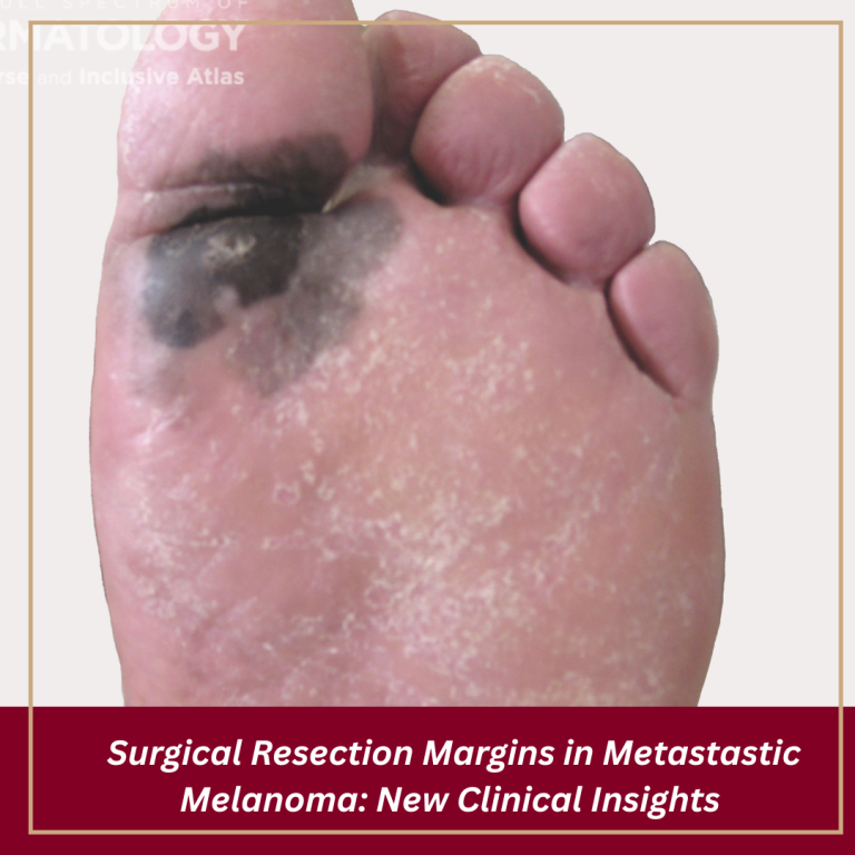 Journal of Drugs in Dermatology JDD featuring Biopsy Type and Metastatic Recurrence in Melanoma: A Cohort Study