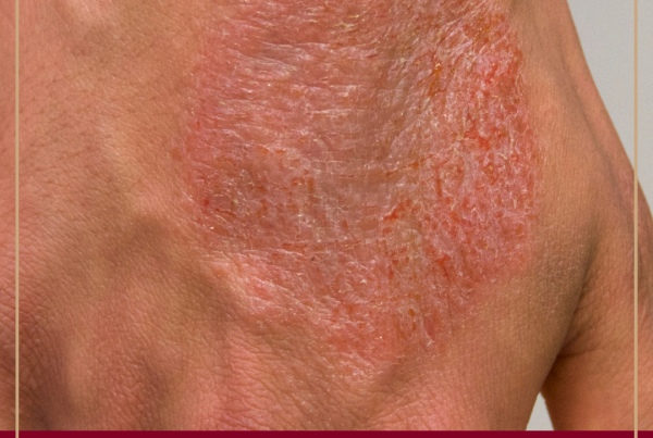 Journal of Drugs in Dermatology JDD featuring The Essential Role of Topical Targeted Therapy in Atopic Dermatitis