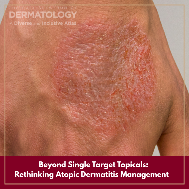 Journal of Drugs in Dermatology JDD featuring The Essential Role of Topical Targeted Therapy in Atopic Dermatitis