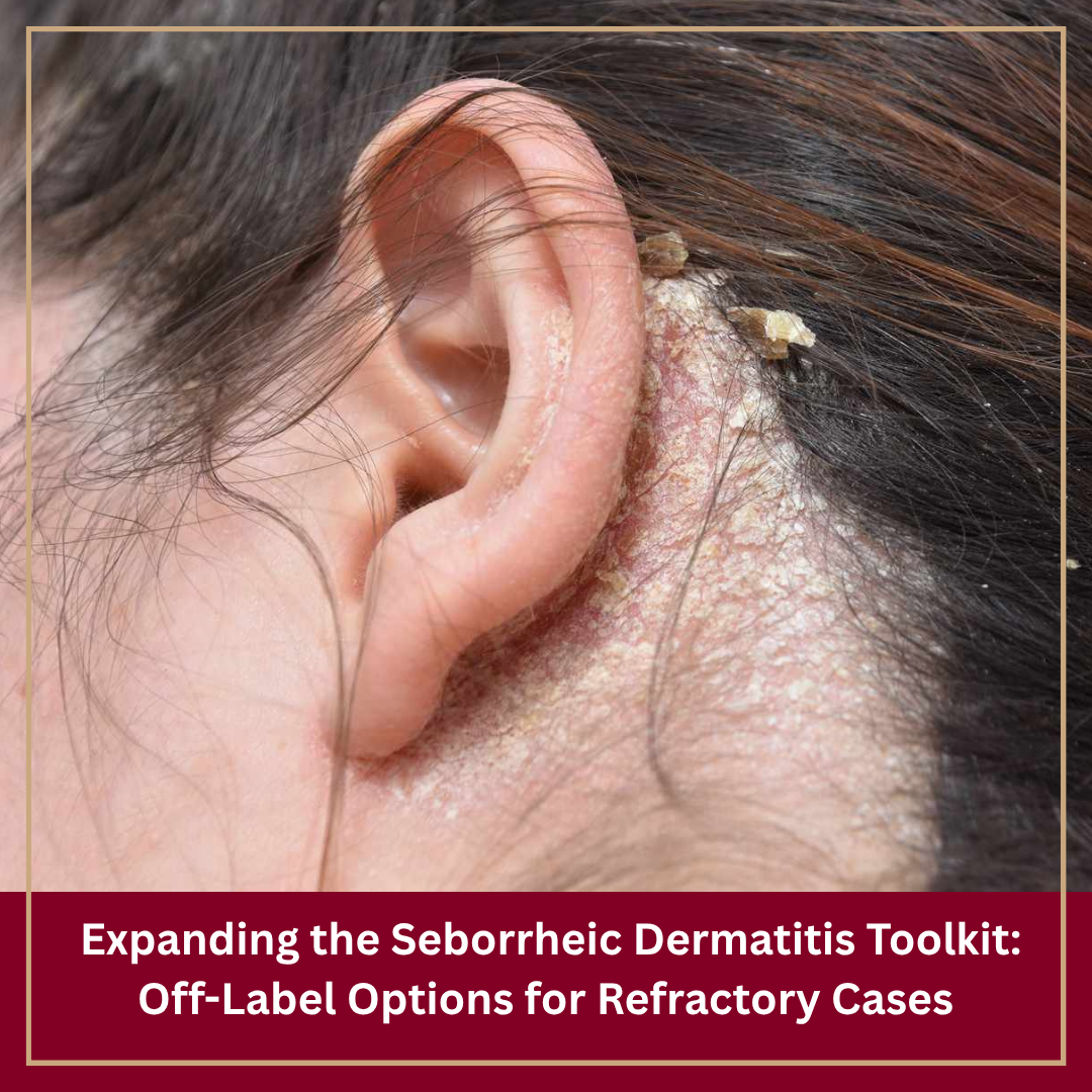 Journal of Drugs in Dermatology JDD featuring A Narrative Review of Seven Off-Label Treatment Options for Seborrheic Dermatitis